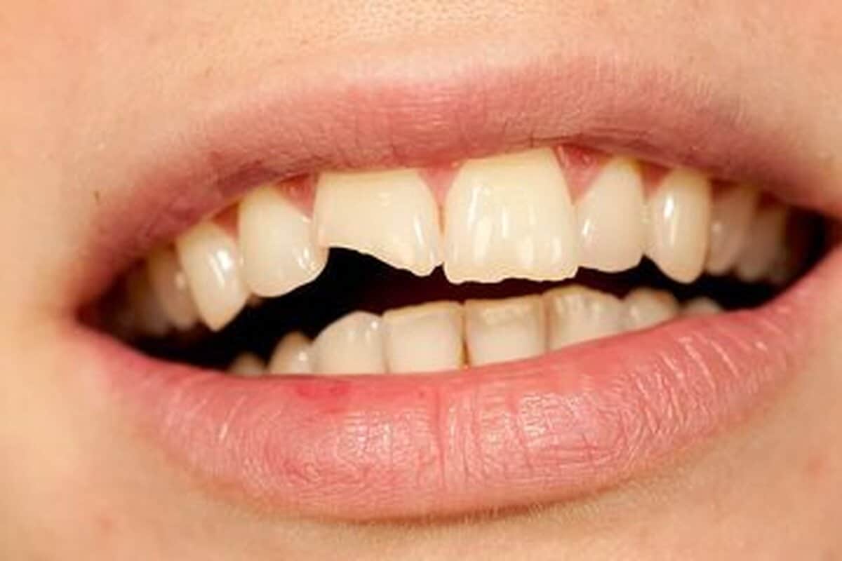 چرا دندان‌ها زود به زود پوسیده می‌شوند؟