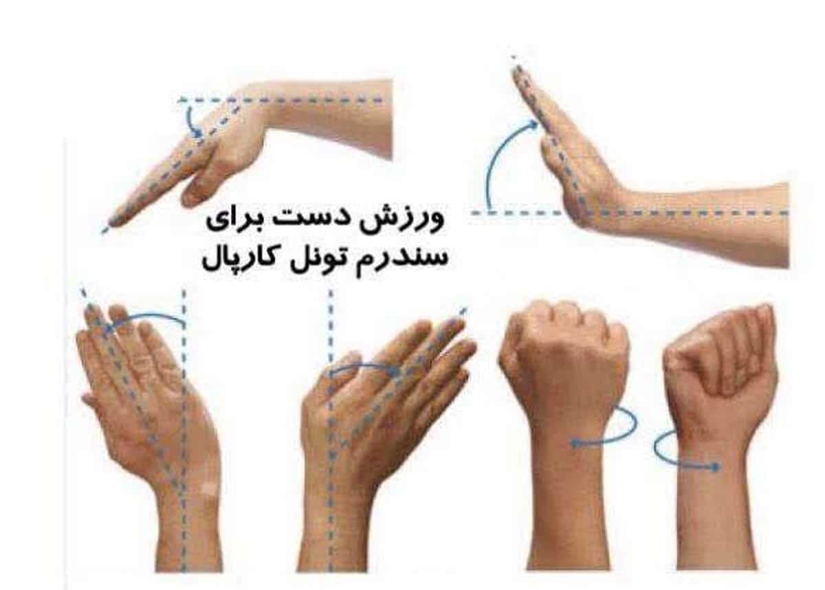 سندروم تونل کارپال چیست؟