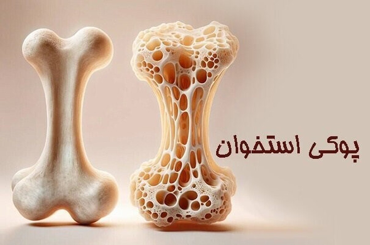 ارتباط بین مصرف زیاد نمک و پوکی استخوان