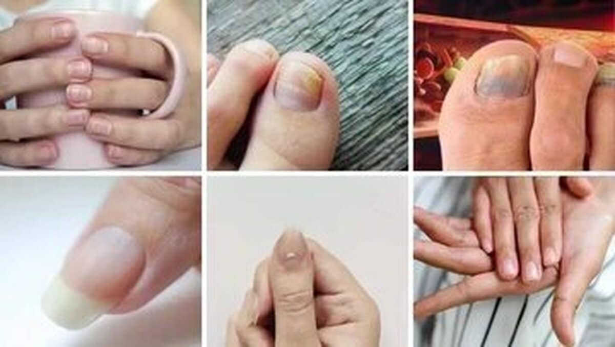 علامت‌های هشداردهنده کلسترول بالا که روی ناخن‌ها ظاهر می‌شود