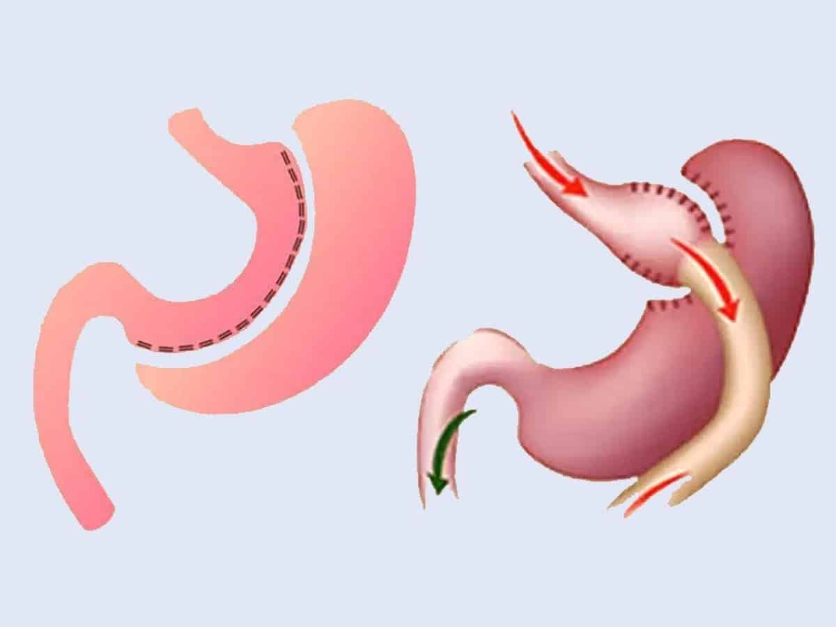 عمل اسلیو معده یا عمل بای پس معده؛ کدام روش کاهش وزن موثرتر است؟