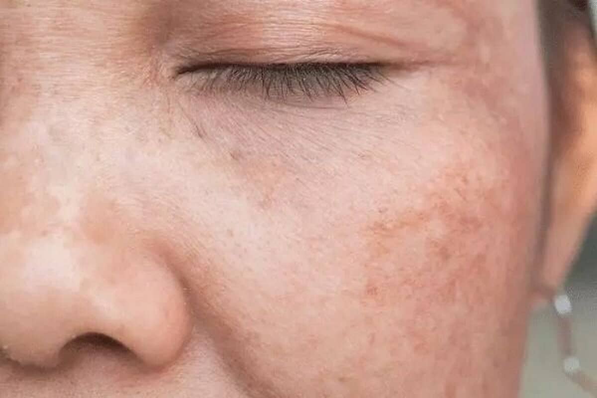 ظاهرشدن این نشانه در پوست یعنی به مشکل صفرا دچار شده‌اید