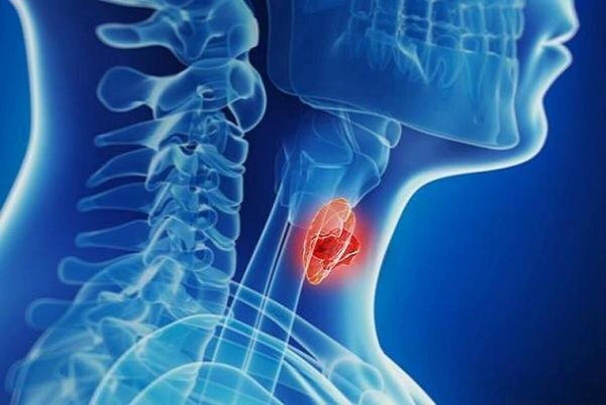 چگونه از ابتلا به انواع سرطان تیروئید پیشگیری کنیم؟