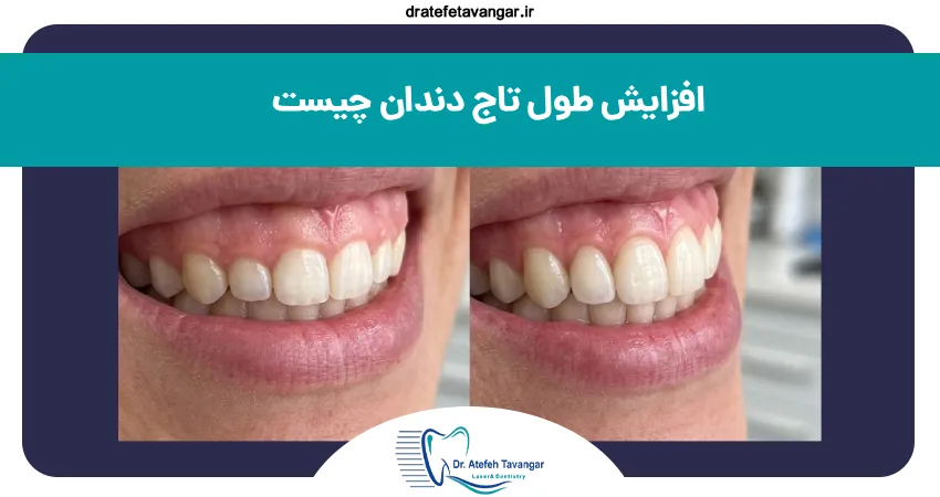 افزایش طول تاج دندان (لیفت لثه) چیست و چگونه انجام می‌شود؟