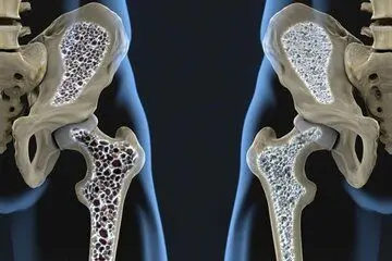 با این روش از ابتلا به پوکی استخوان فرار کنید