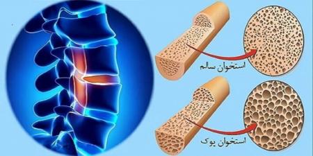 پوکی استخوان از این سن و سال آغاز میشود