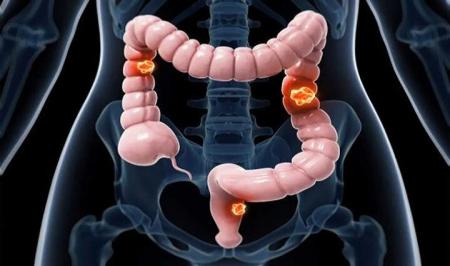 تأثیر عجیب کاهش جزئی پروتئین BECLIN1 بر سلامت روده