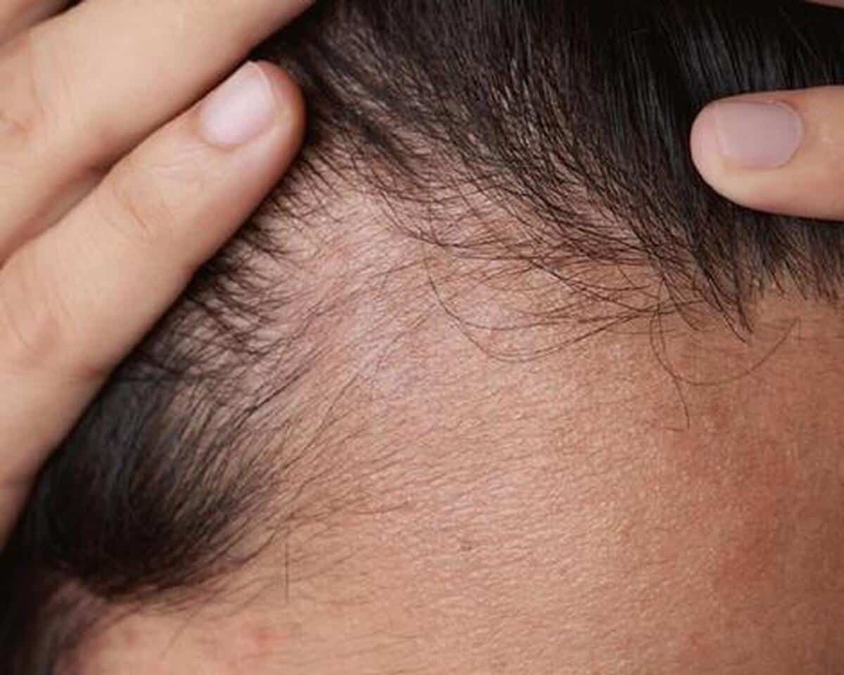 درمانی جدید برای ریزش مو