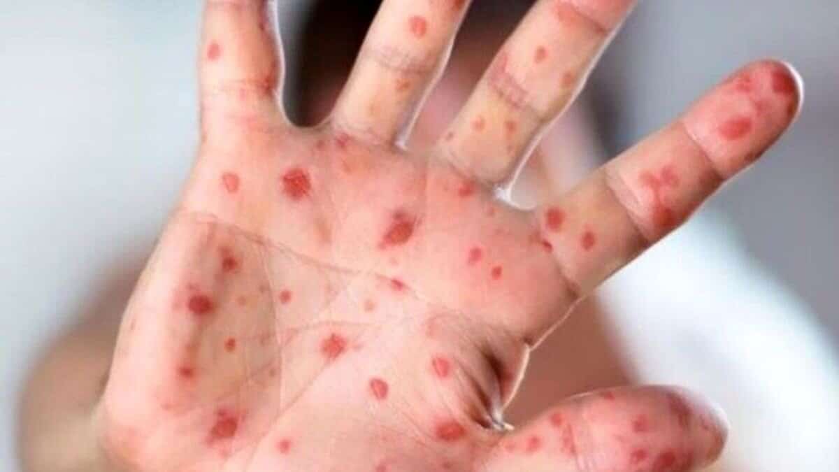 زنگ خطر شیوع بیماری کشنده در یزد/ آمار موارد ابتلا؛ بیماران ایرانی هستند یا اتباع؟