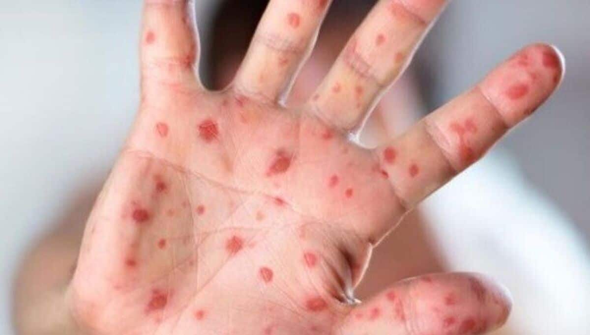 زنگ خطر شیوع سرخک در یزد به صدا درآمد