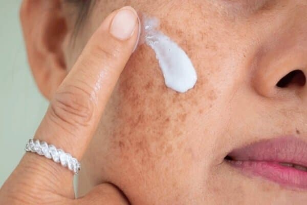 لکه‌های پوستی را چگونه درمان کنیم؟